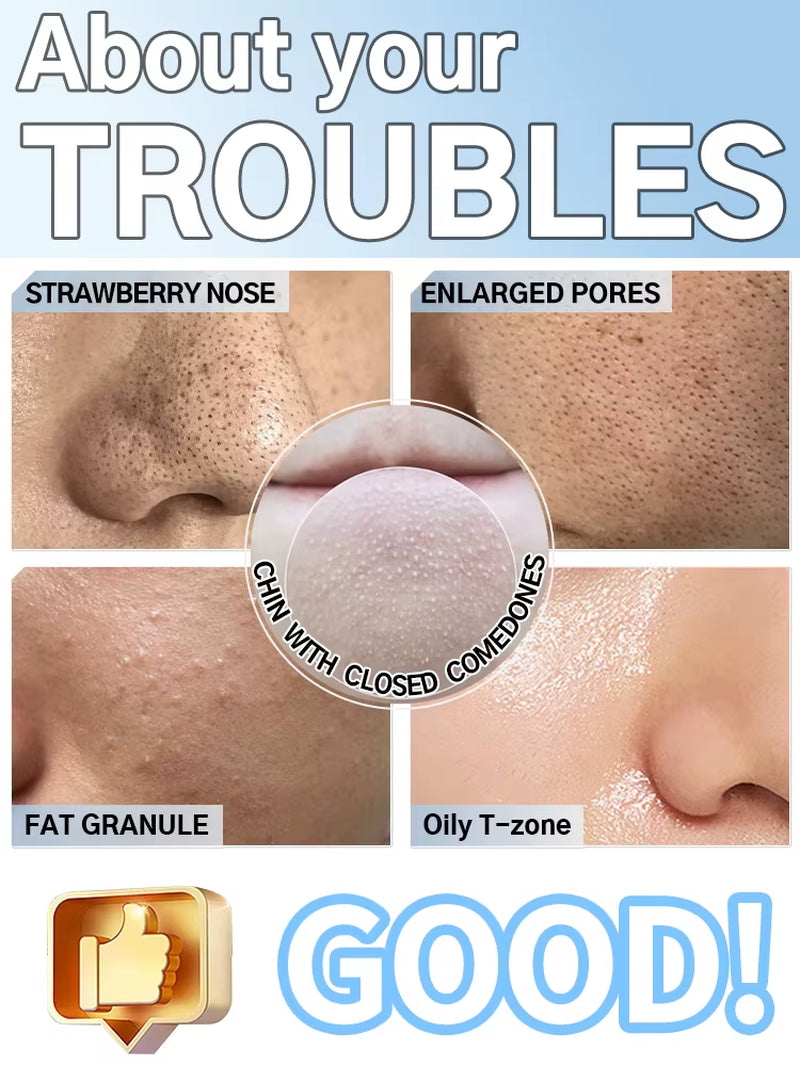 2025 New Upgrade Nose Blackhead Remover Pimples and Blackheads Vacuum from the Face Cleaner Tool